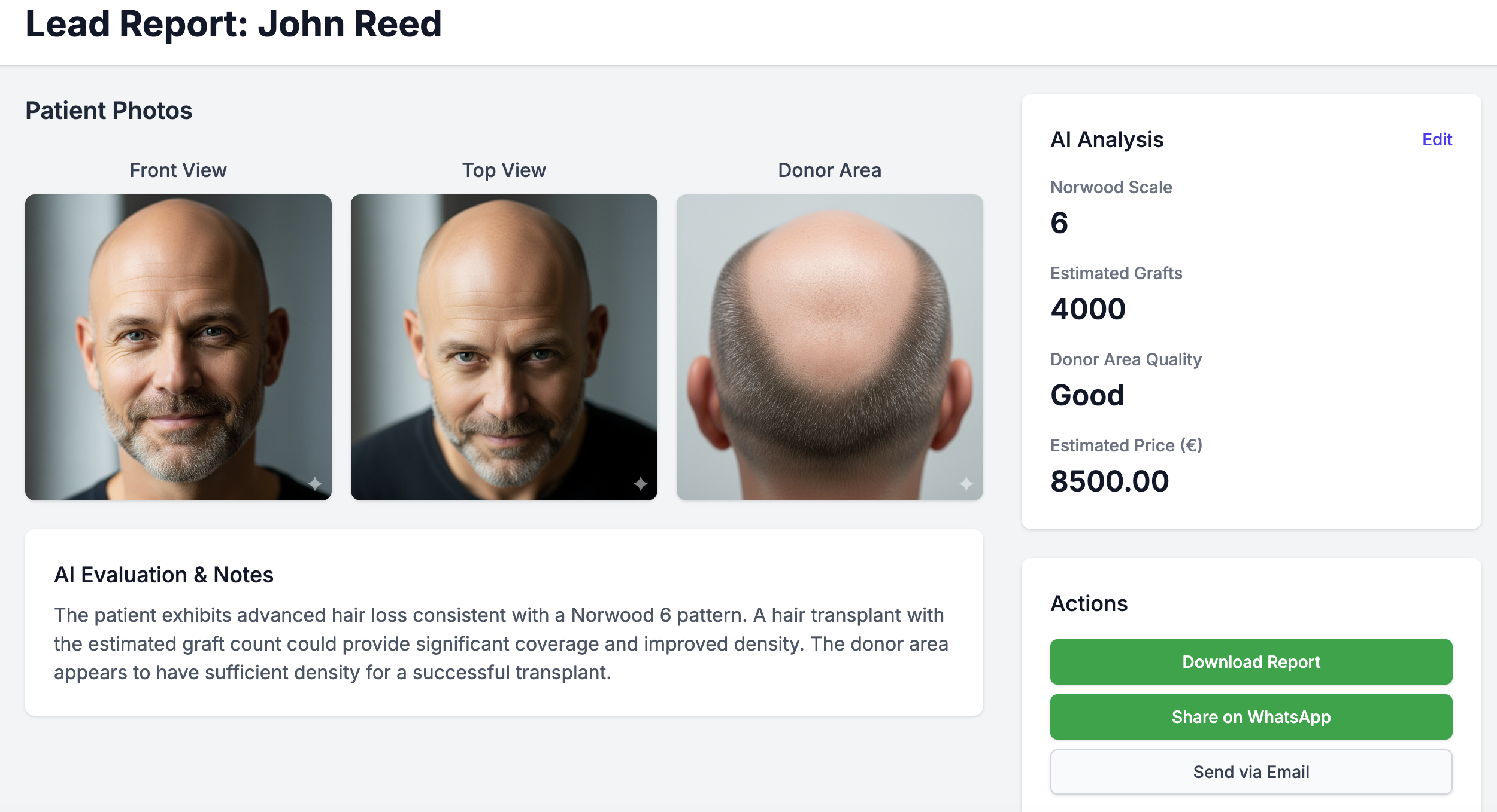 Dashboard showing an AI-generated hair transplant report